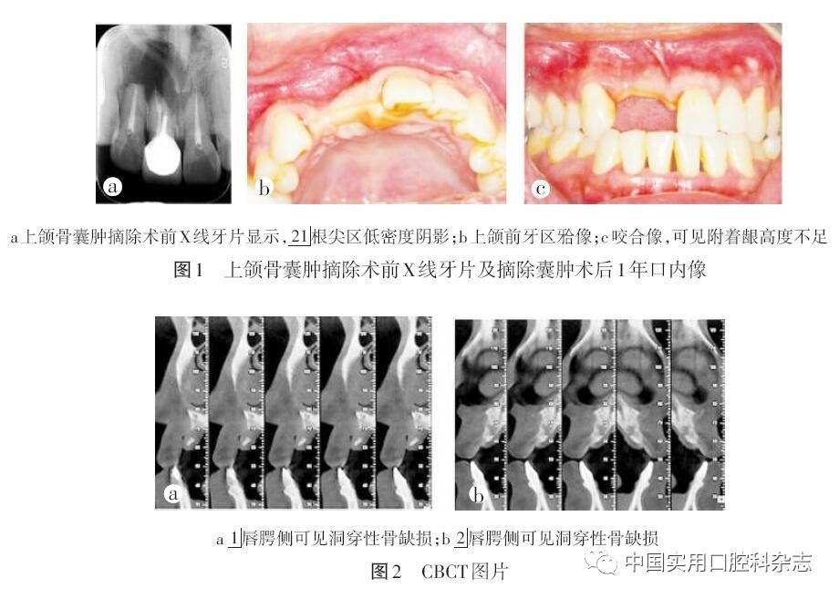 12缺失,缺牙区剩余牙槽嵴顶较窄,约2 ~ 3 mm宽,附着龈高度不足,近远中