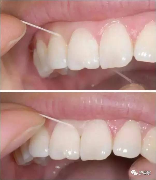 在其他牙缝也是重复以上动作,清理每一个够得到的牙缝和牙龈下面
