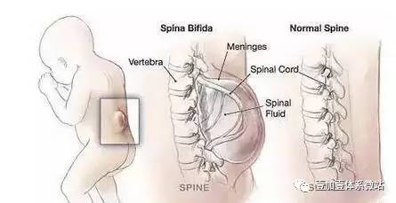 3,腰骶段先天异常:腰骶段畸形可使发病率增高,这些异常常造成椎间隙