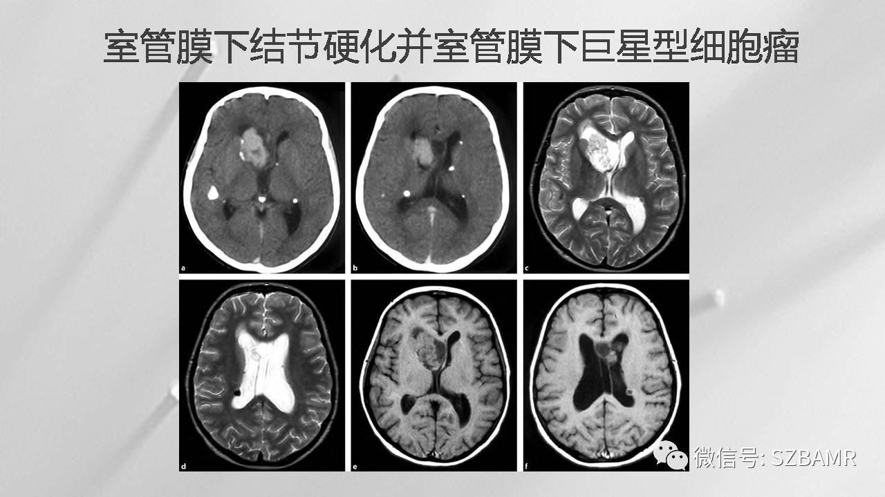 影像科普结节性硬化症