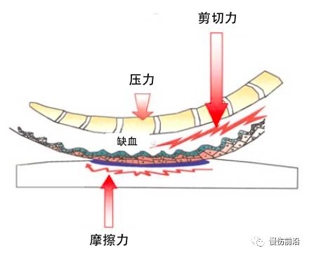 压力性损伤发生机制之三力合一