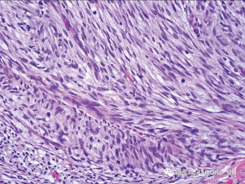 组织学形态由增生的梭形细胞构成,肿瘤细胞可排列成束状,波浪状,车辐
