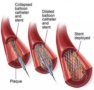 心脏支架手术