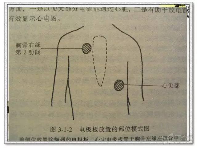 心脏电击除颤及除颤仪的使用