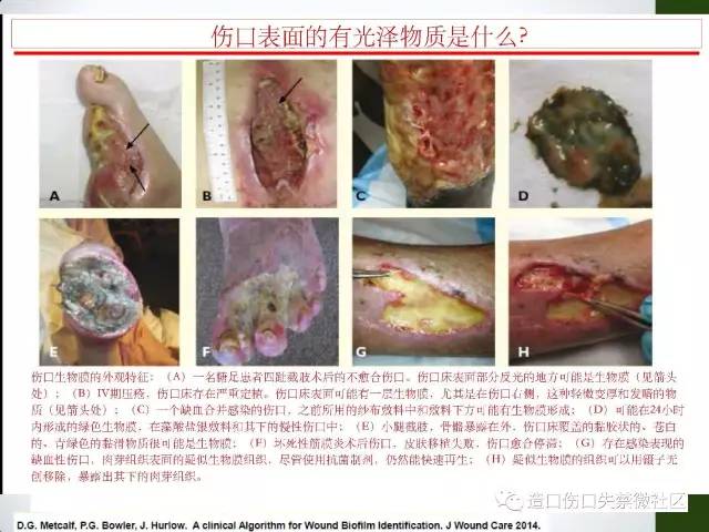 你只知道压疮,那关于"腐肉"呢?