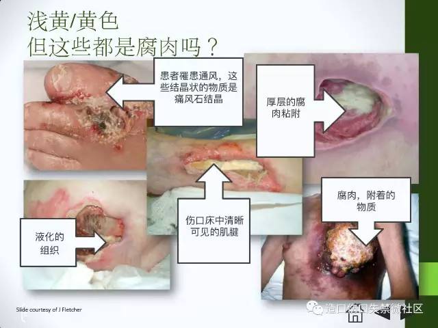 你只知道压疮,那关于"腐肉"呢?