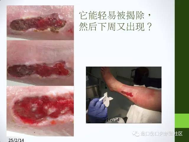 你只知道压疮,那关于"腐肉"呢?