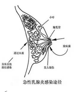 一分钟乳房健康检测,专家教你如何鉴别乳腺疾病