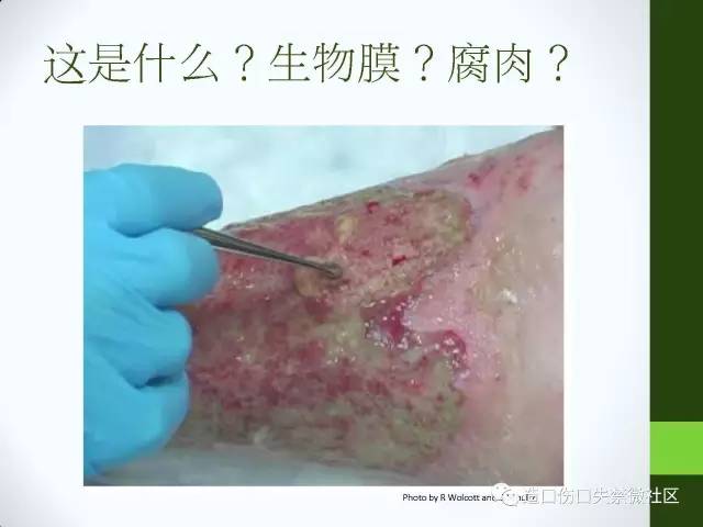 你只知道压疮,那关于"腐肉"呢?