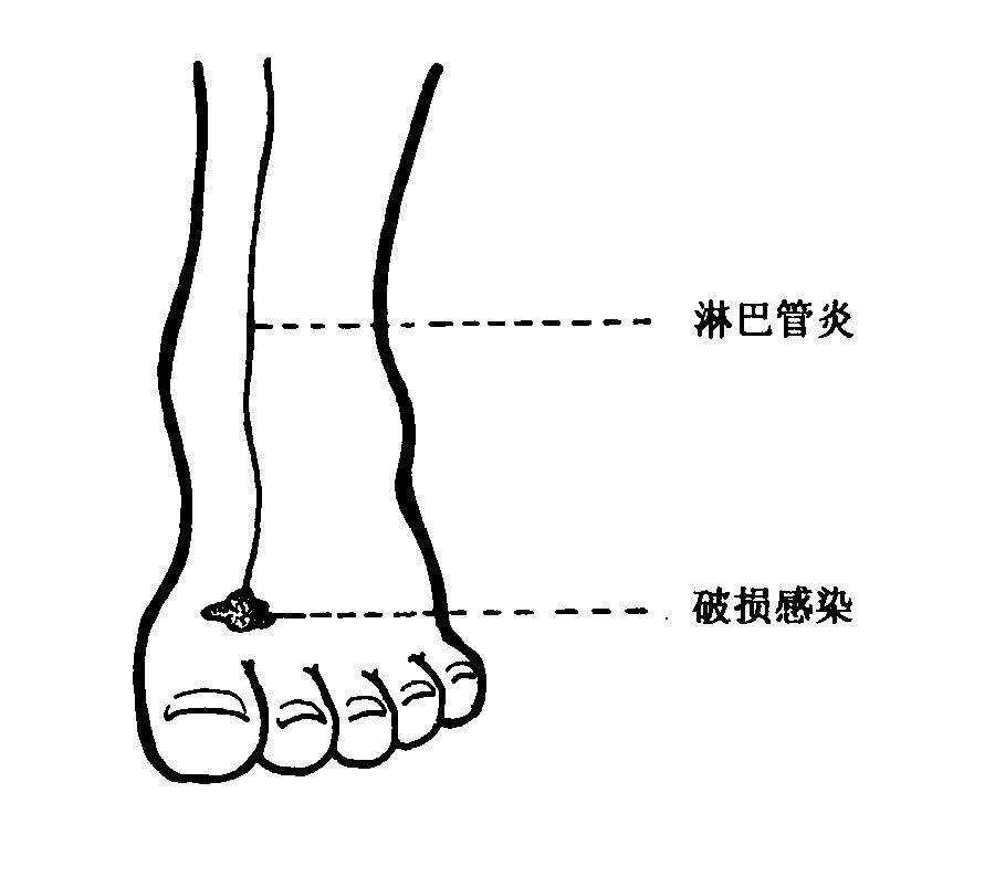 正文  急性淋巴管炎,又称"红线", 糜烂型或水疱型脚气得不到有效治疗