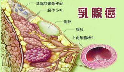 乳腺增生不可怕选对治疗很重要