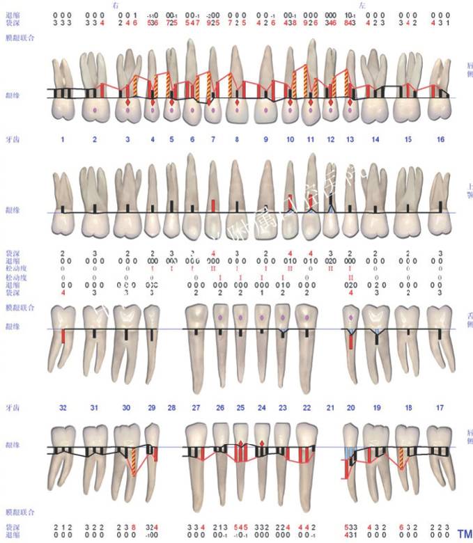 mm:16,15,14,13,12,11,21,22,23,24,25,35,37,41,46,其余牙周探诊深度