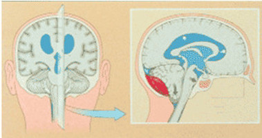 脑瘤患者需要警惕的另一种凶险:脑疝