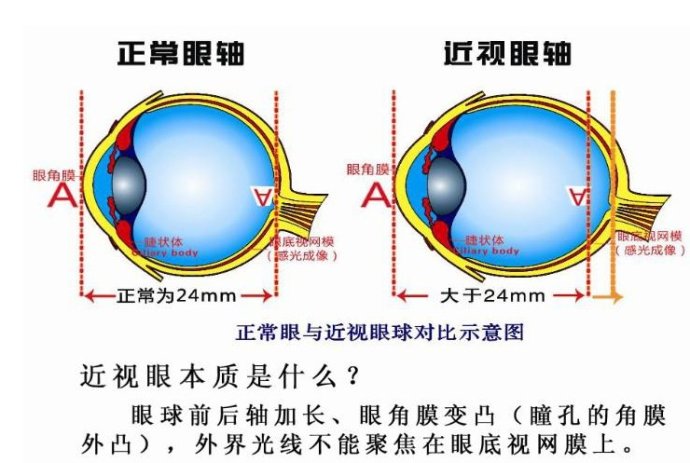 本应聚焦在"底片"视网膜上,然后形成信号被大脑接收,但近视患者的成像