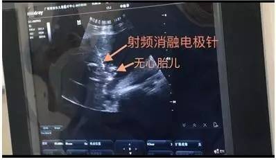 市妇儿医疗中心成功开展第一例射频消融减胎术