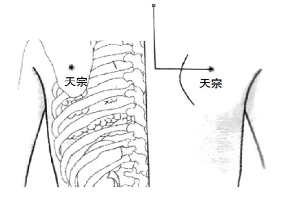 肩胛疼痛手臂麻木让人帮您按按天宗穴