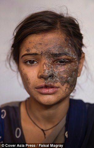 印度20岁女孩被父亲泼硫酸毁容 只因她举报了爸爸的罪行(组图)