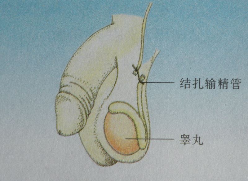 男人结扎后雄风就会不在