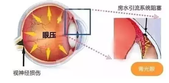 这里所说的眼压即眼球内的压力,正常范围是10～21mmhg.