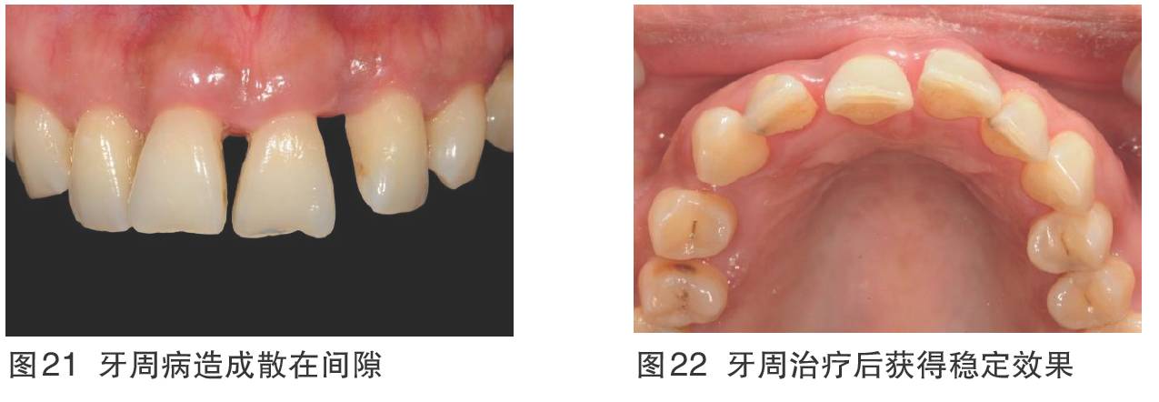 切端或邻面的局部缺损(详见图1～11②由于牙齿发育异常造成的过小牙