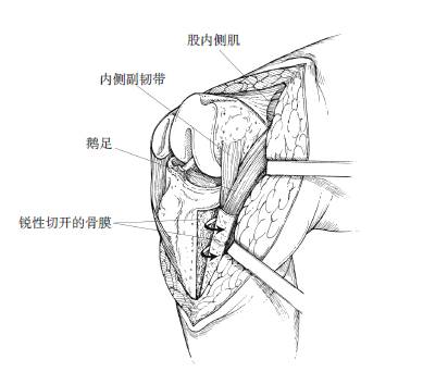 膝关节内翻畸形的内侧松解