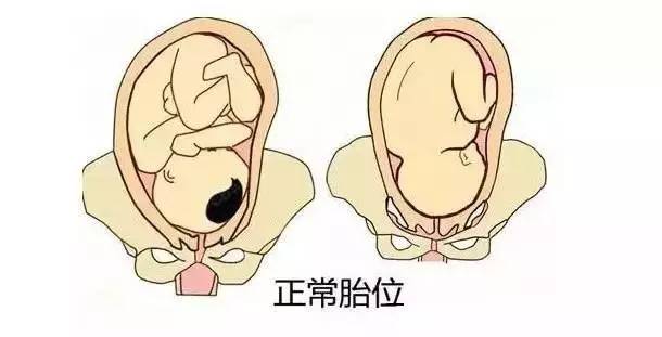 就是头先露,这样的胎位叫头位,根据胎儿头部的屈伸程度,头位还分:枕前