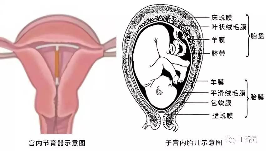 一般放置子宫腔的底部,而生产时的胎儿,位于重重结构包裹(胎膜,羊水