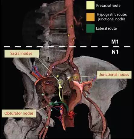 肿瘤细胞可沿髂内血管内脏分支转移至髂内外结合部淋巴结;骶前转移