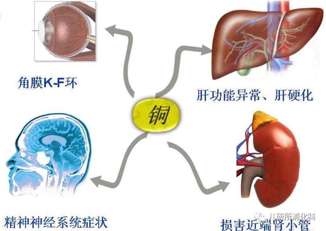 多的铜在各组织尤其是肝脏,大脑,角膜,肾脏等部位沉积,导致肝功能受损