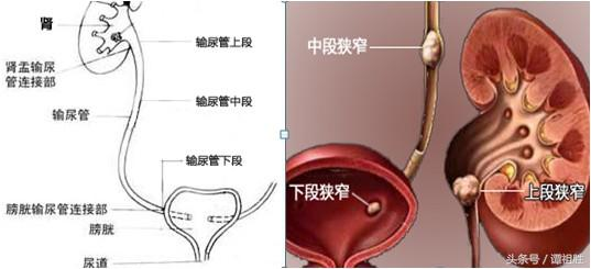 老年人得尿路结石该怎么办?