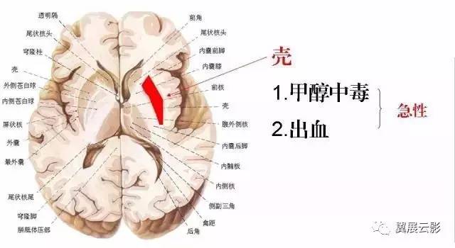 基底节对称病变并不长几张简图就搞定了