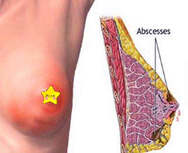 乳腺炎疼怎么办