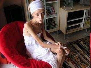 典型例子就是法国零码模特伊莎贝尔·卡罗,她因以骨瘦如柴如同干尸