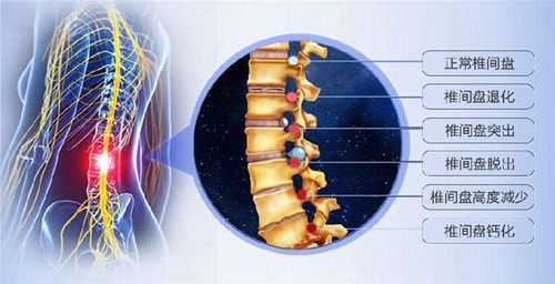 健康常识:腰椎间盘突出症的15个认知误区(上篇)