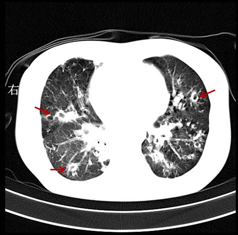 请注意:CT发现这种肺结节,不需要复查_突袭网