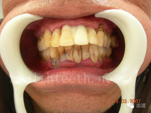 牙周大量牙石堆积外院做的牙周固定,牙片显示牙槽骨的水平吸收牙片