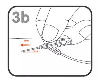 3b.见回血后角度降至5-10度持续进针0.2cm