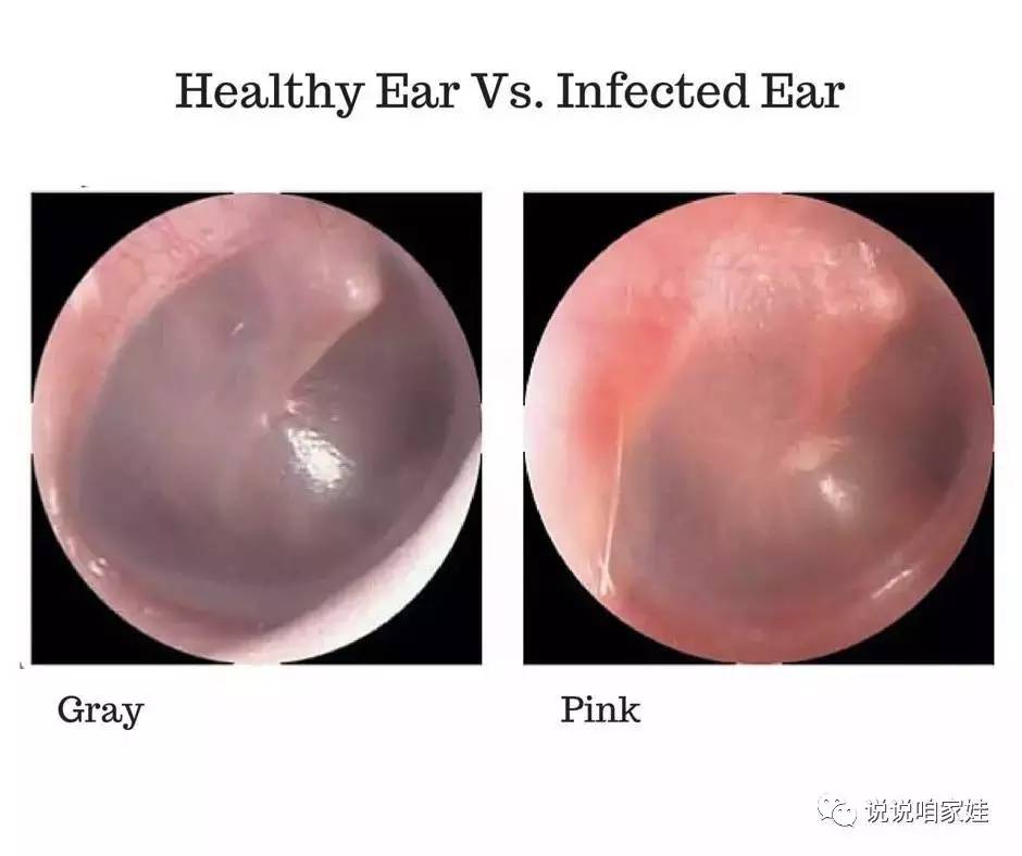 ear-infection-symptoms-causes-and-treatment-scientific-animations