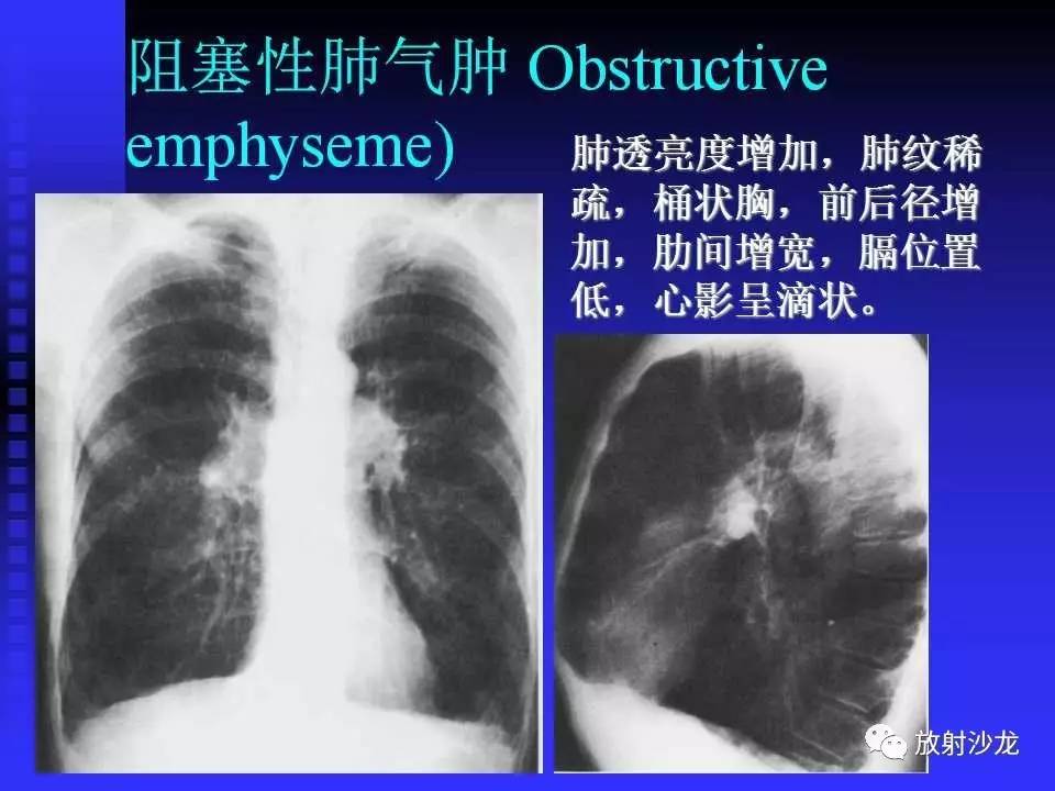 胸x片读片全面分析 肺部常见病的x线诊断