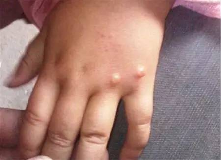 而水痘的疹子变化很快,出现后几个小时就会变成水泡,比手足口病的疹子