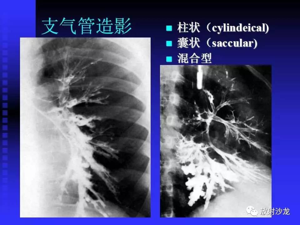 胸x片读片全面分析肺部常见病的x线诊断