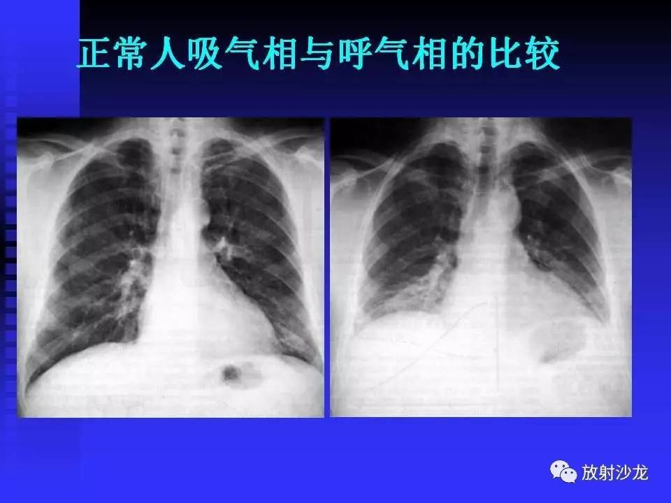 胸x片读片全面分析肺部常见病的x线诊断