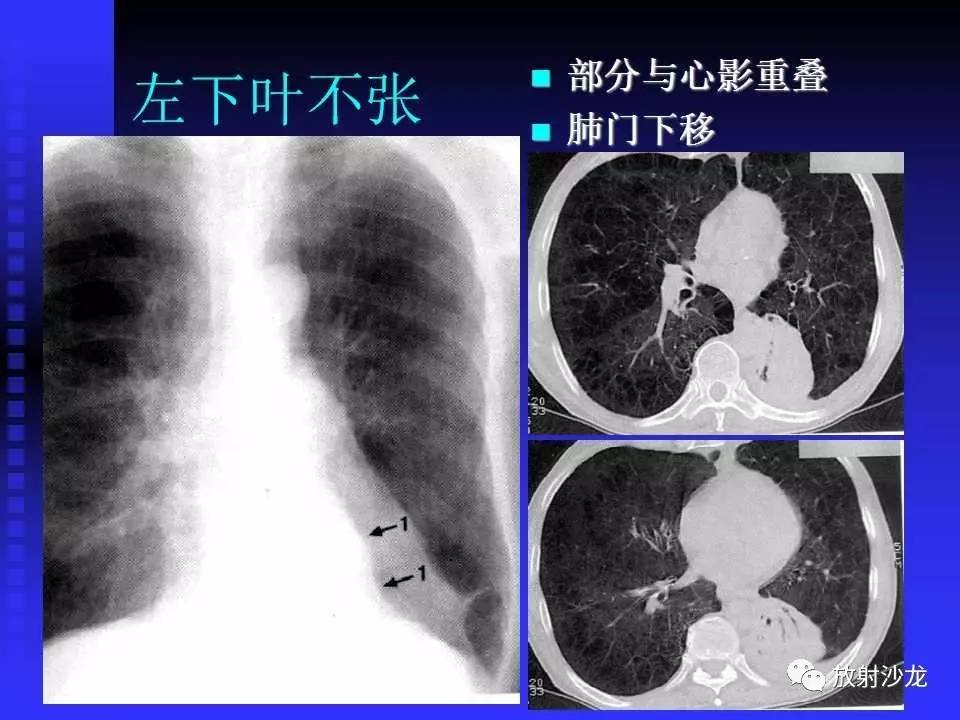 胸x片读片全面分析 肺部常见病的x线诊断