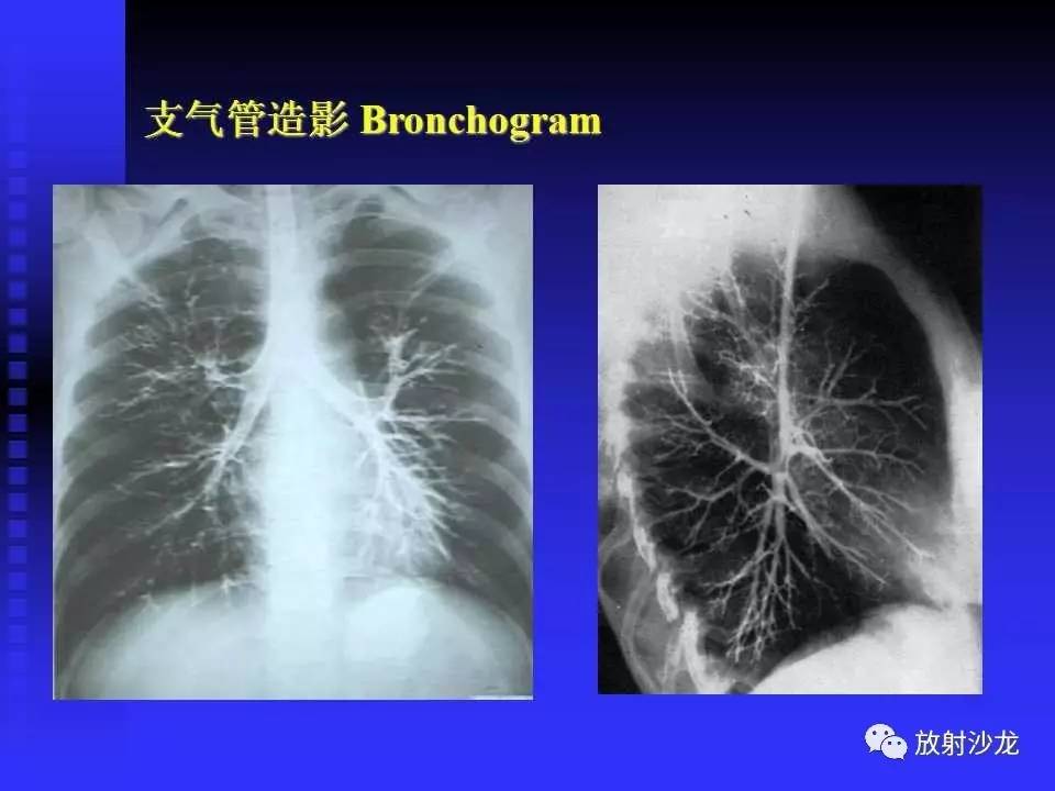 胸x片读片全面分析 肺部常见病的x线诊断