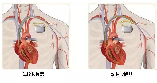 安置永久性心脏起搏器手术后需知