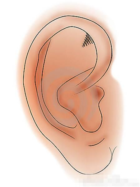 如何从耳朵大小形状可看出疾病信号?