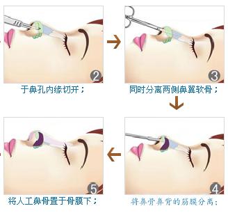 隆鼻后头痛怎么办