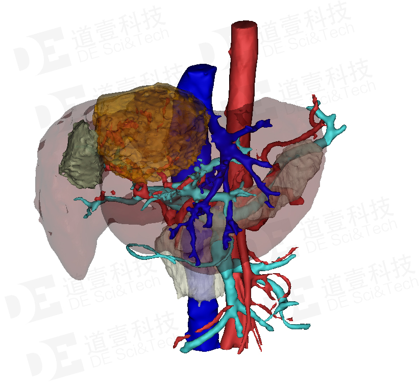 道壹科技肝脏三维重建效果