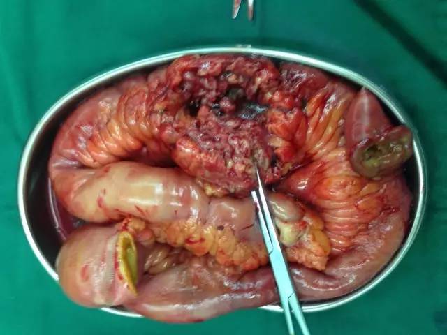 行小肠肿瘤切除术,切除小肠约50厘米(包括穿孔之肠肿瘤),冲洗腹腔