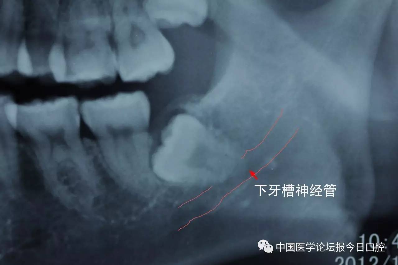 发生原因:①下颌第三磨牙根尖和下牙槽神经管解剖位置邻近;②拔牙方法